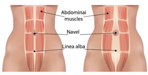 Abdominal pain